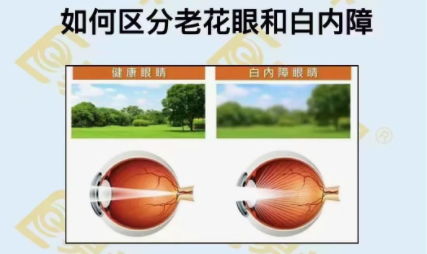 如何區(qū)分老花眼和白內(nèi)障？