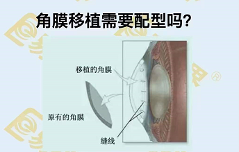 角膜移植需要配型嗎？